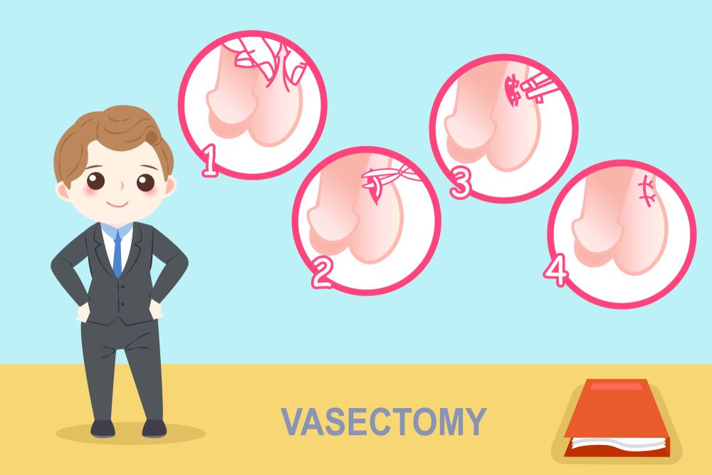 Jak se provádí vasektomie - co to je, ilustrace