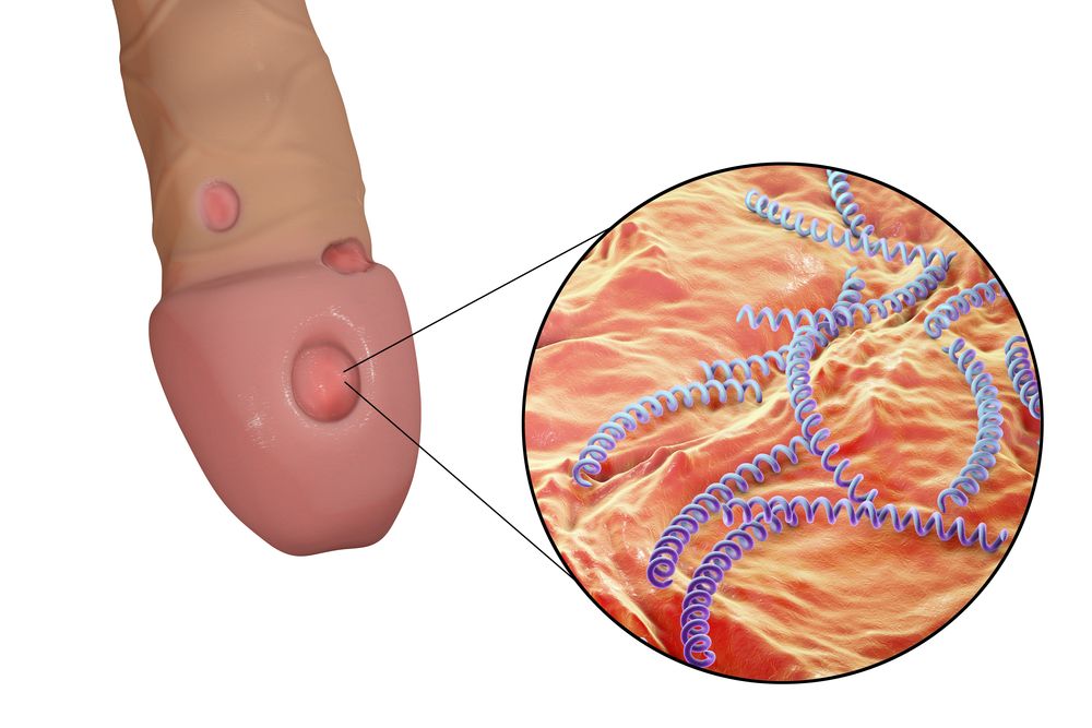 Syfilis - tvrdý vřed, ulcus durum na penisu
