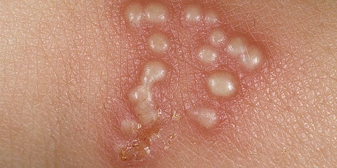 Genitální herpes - puchýře způsobené virem herpes siplex